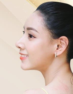 Nâng mũi cấu trúc