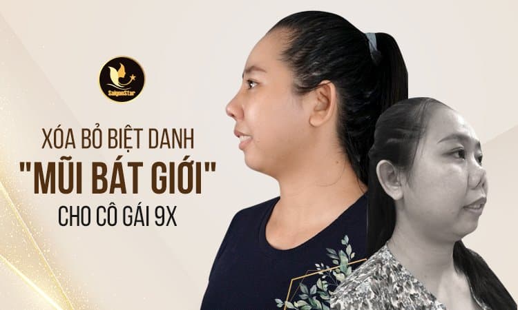 Khắc phục biến chứng mũi co rút biến dạng