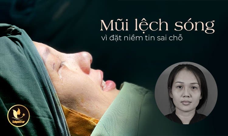 Mũi lệch sóng vì đặt niềm tin sai chỗ