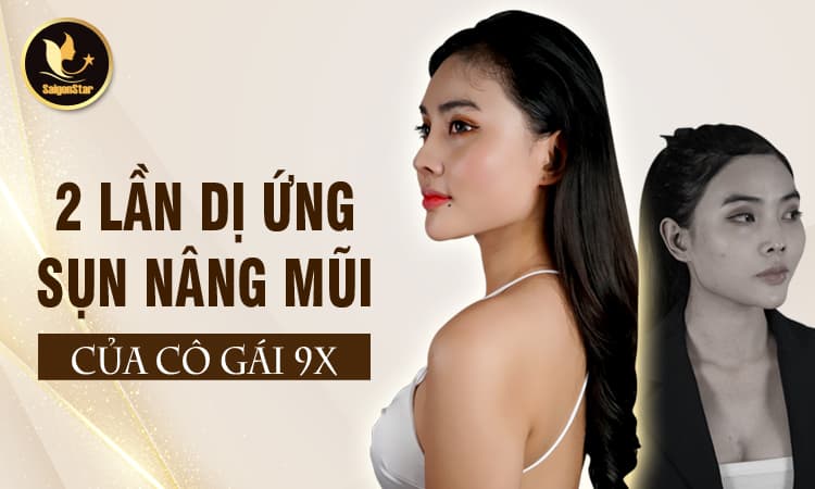 2 lần dị ứng sụn nâng mũi của cô gái 9X