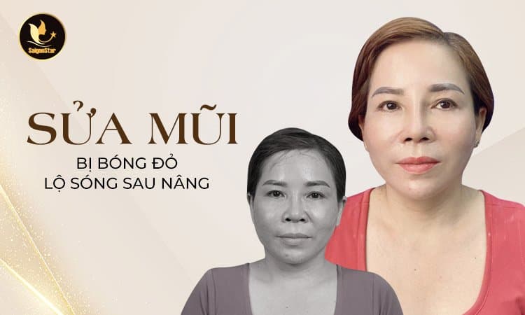 Sửa mũi bị lộ sóng bóng đỏ sau nâng