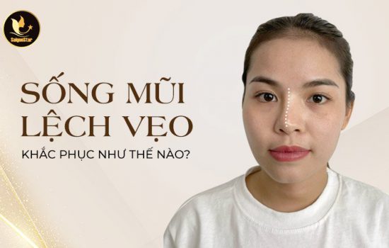 Sống mũi lệch vẹo khắc phục như thế nào?