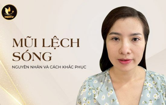 Mũi lệch sóng: Nguyên nhân và cách khắc phục